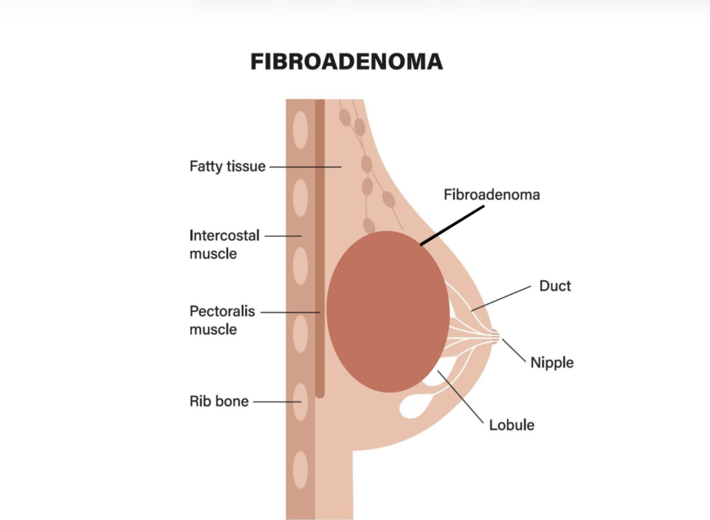 Fibroadenoma 
